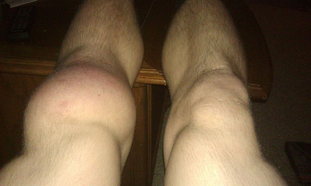gjurit para trajtimit me Osteflex